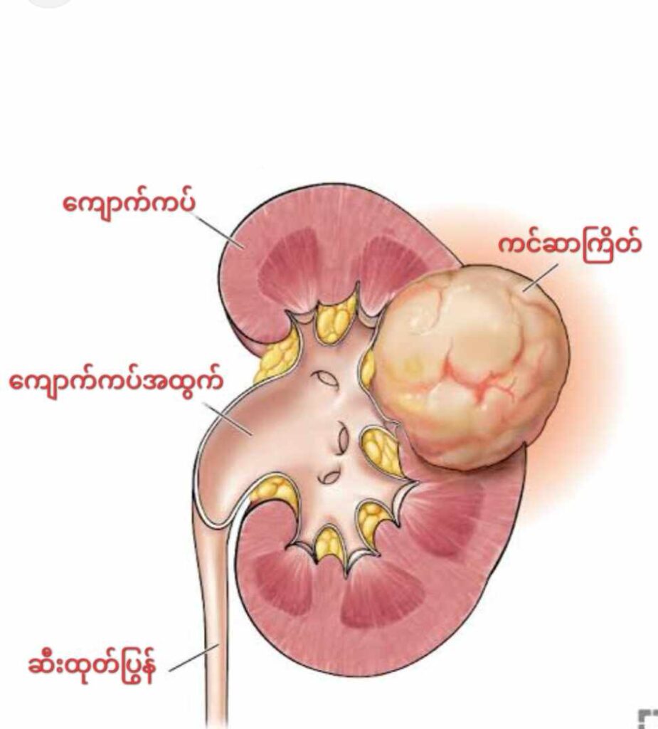 ​ကျောက်ကပ်ကင်ဆာ ( Renal Cell Carcinoma )