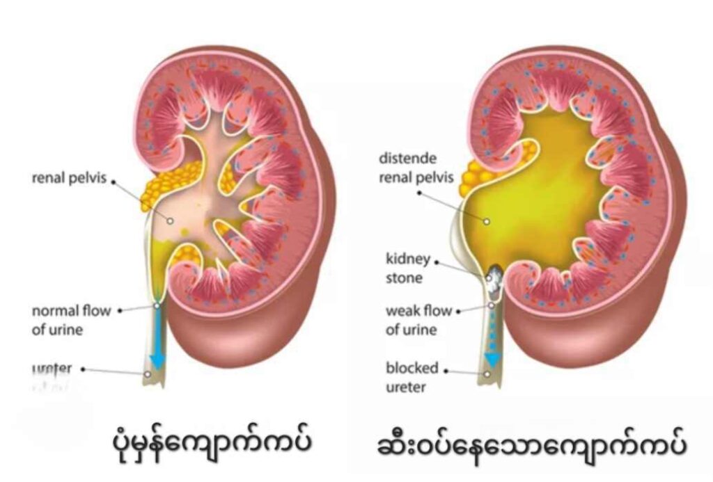 ​ကျောက်ကပ်​ရေစုခြင်း သို့မဟုတ် ဆီးဝပ်ခြင်း ( Hydronephrosis )